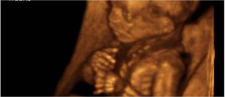17 week ultrasound 3d